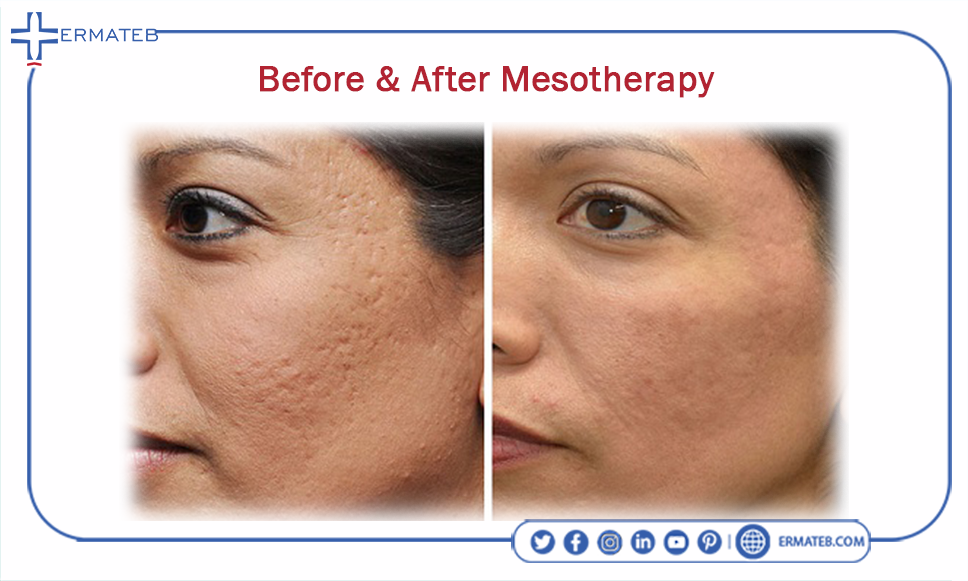 before & after mesotherapy
